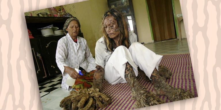 Rare-Disease-Day-epidermodysplasia-verruciformis